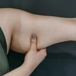 problème peau sous les bras lifting