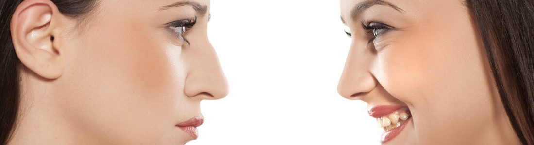 Fini le complexe du nez imparfait !