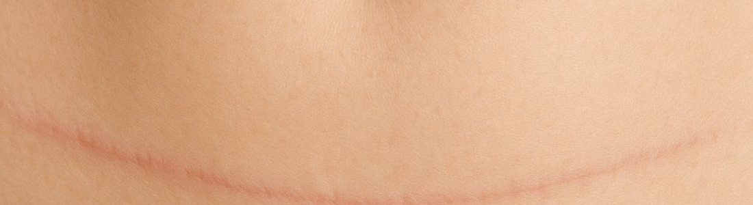 Chirurgie esthétique : comment atténuer les cicatrices postopératoires ?